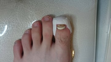母趾の爪が生えてこない 一般社団法人 足の番人 公式 足の知識 活動報告